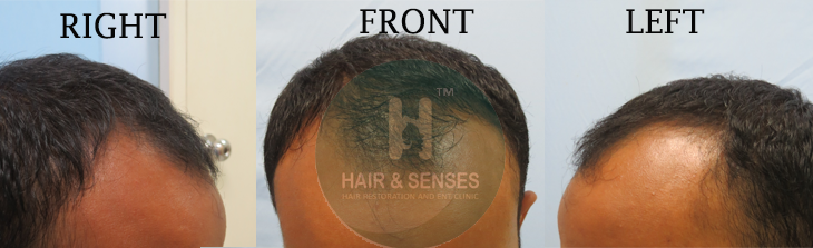 Before Procedure 2500